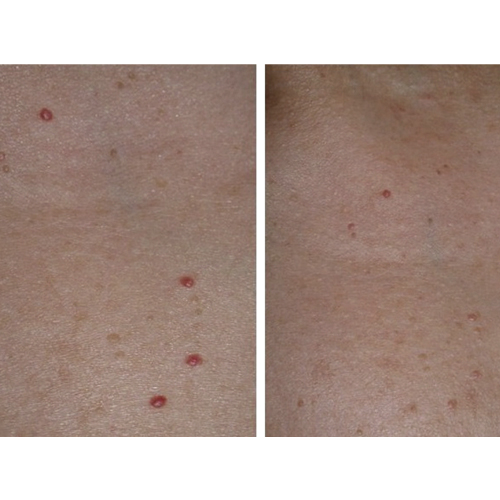 Talent Laser Clinic & med spa | Cherry Angiomas Removal - image gallery 2