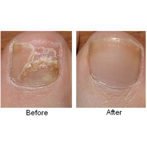 Talent Laser Clinic & med spa | Nail Fungus Removal Treatment - image gallery 1