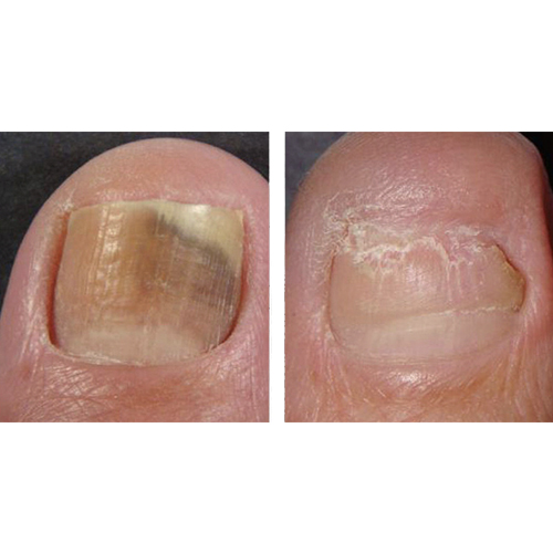 Talent Laser Clinic & med spa | Nail Fungus Removal Treatment - image gallery 2