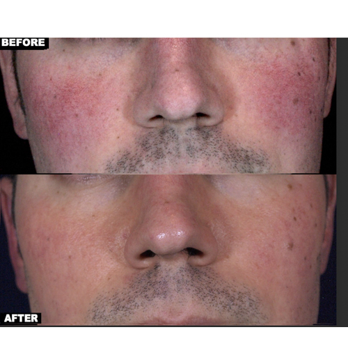 Talent Laser Clinic & med spa | Rosacea, Facial Redness & Broken Blood Vessels Treatments - gallery image 1