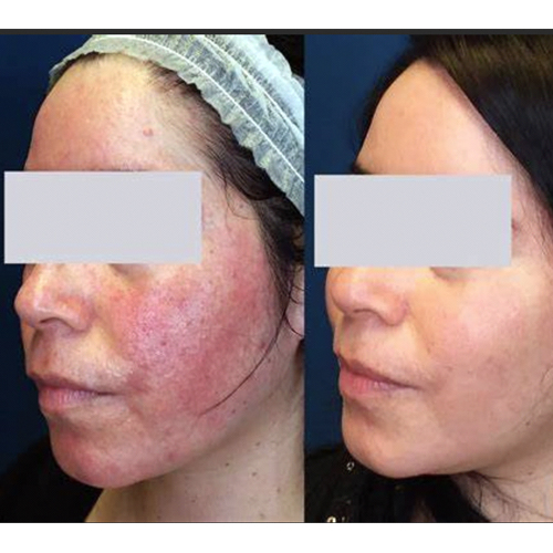 Talent Laser Clinic & med spa | Rosacea, Facial Redness & Broken Blood Vessels Treatments - gallery image 2